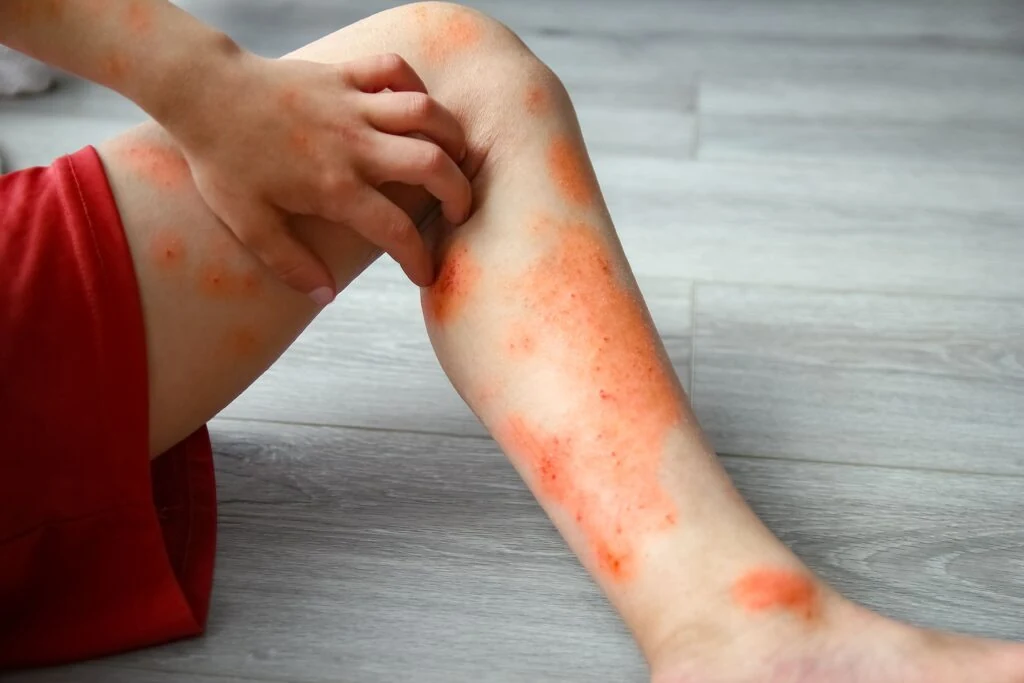 Dermatite Atópica Infantil