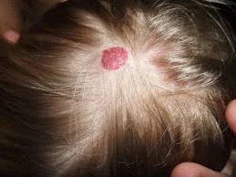 Hemangiomas e Lesões Vasculares da Infância