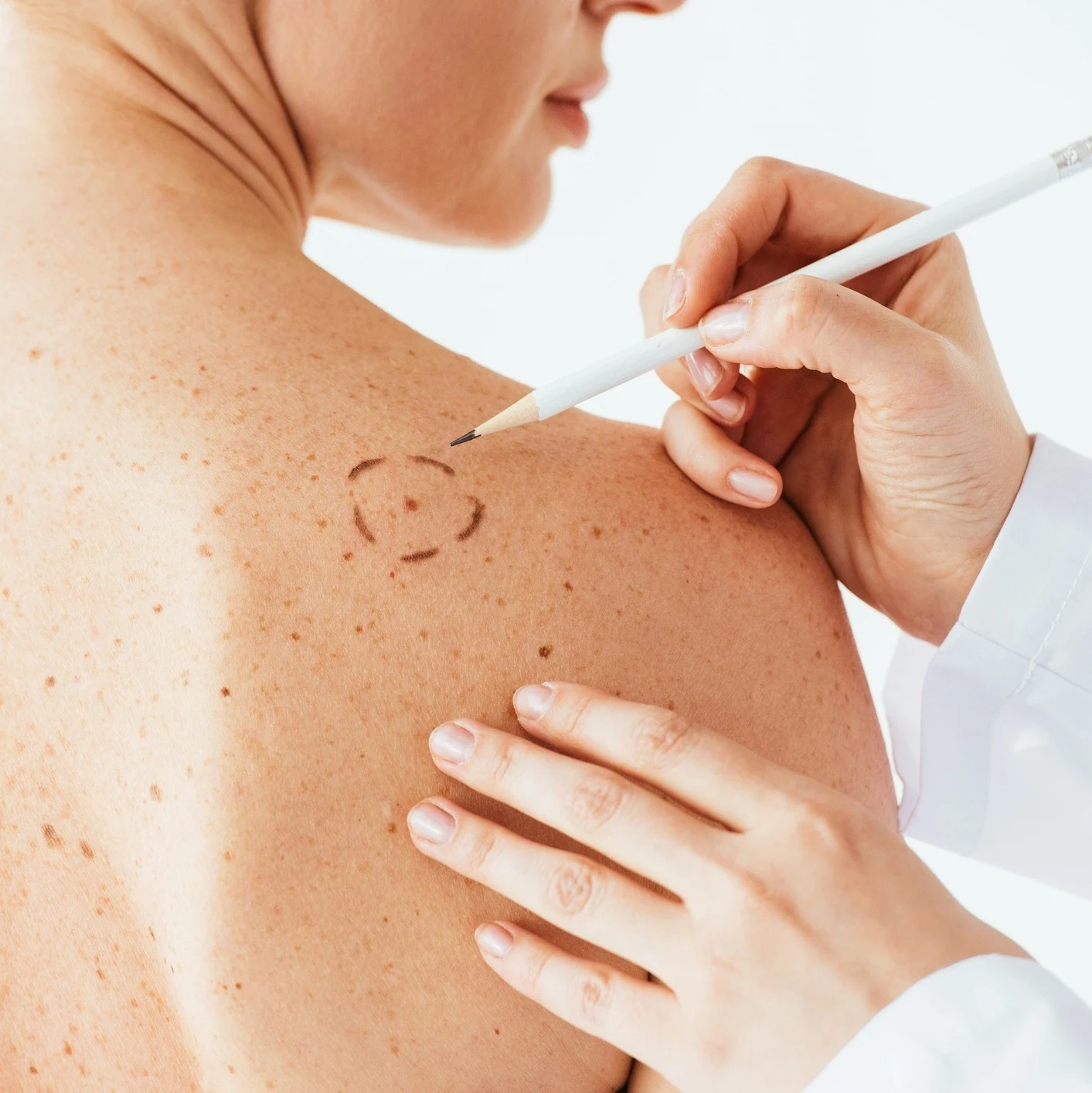 Acne na Adolescência